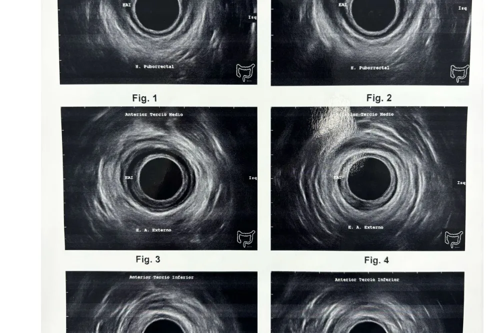 Ultrasonido endoanal y endorrectal 360°